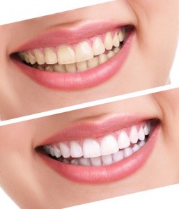 Dentes mais Brancos? Branqueamento