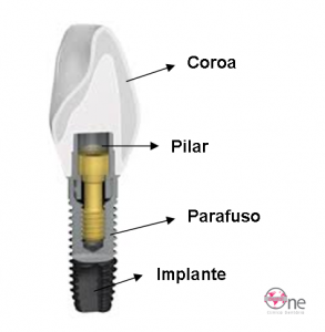 Implantes - Publicidade Enganosa